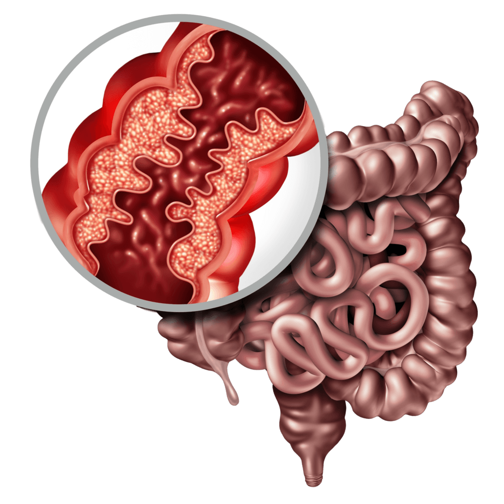 Radiation enteritis soligenix